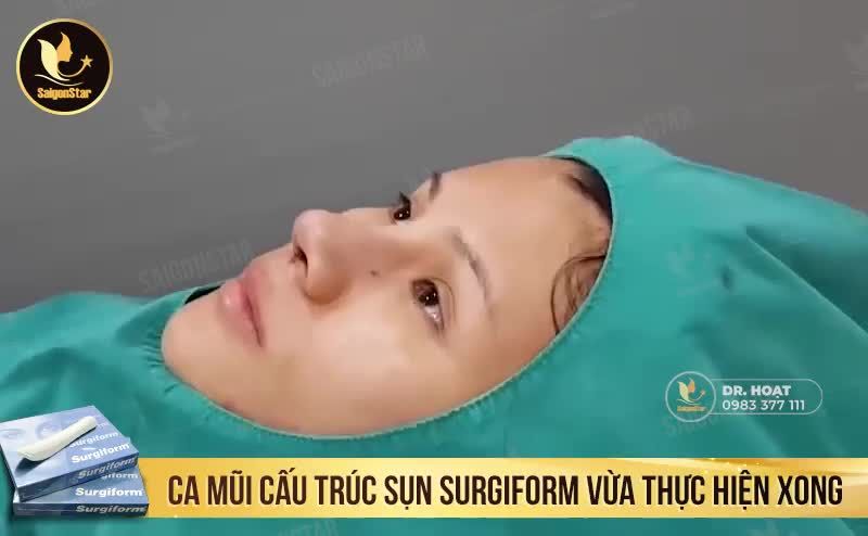 CẬN CẢNH CA MŨI CẤU TRÚC SỤN SURGIFORM VỪA THỰC HIỆN XONG