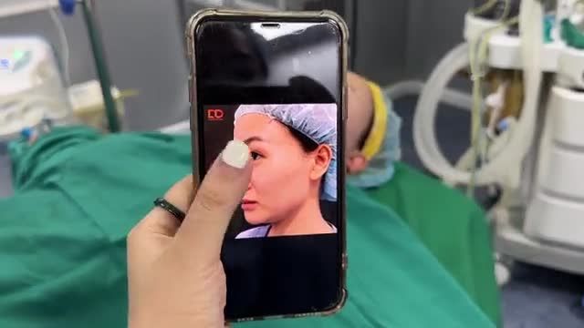 Bạn khách hàng đã cấy mỡ xong, khuôn mặt đầy đặn, căng bóng, mịn màng rất đẹp.