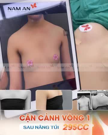 Nâng cấp vòng 1 - quyến rũ ngay sau 60p Giảm ngay 30% khi nâng ngực tháng này