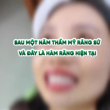 TÁI KHÁM SAU MỘT NĂM THẨM MỸ RĂNG SỨ, HÀM RĂNG HIỆN TẠI CỦA KHÁCH HÀNG CÓ VẤN ĐỀ GÌ?