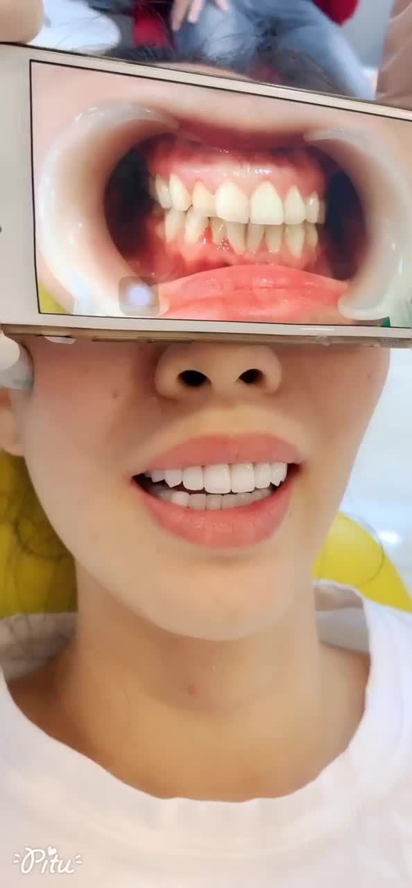 Nha khoa Xs Hoàn thành xong muộn bộ 16 răng sứ Lava Plus cho chị khách hàng .