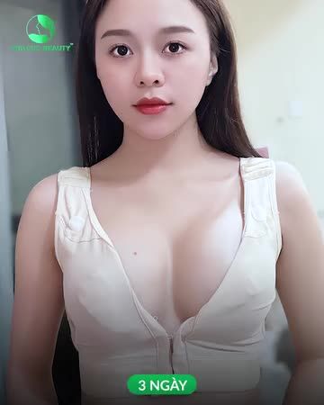 Ngực TC CĂNG MỀM, TỰ NHIÊN  - Khắc phục hoàn toàn tình trạng teo lép bẩm sinh - Không đau. Không chảy máu - Hồi phục nhanh sau 7 ngày