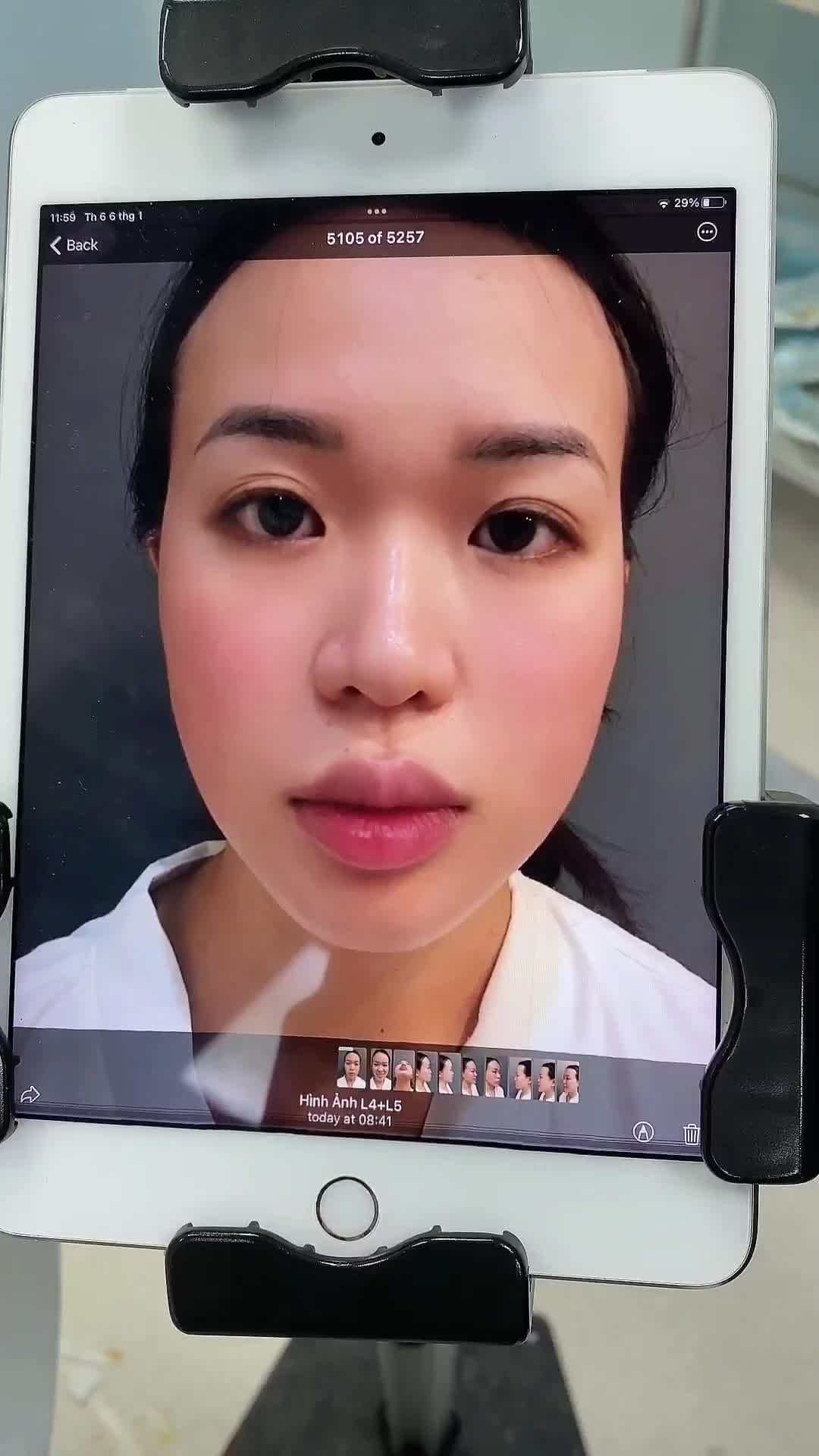 Bác sĩ Điền sau khi thực hiện ly tâm mỡ đã thu về 1 lượng mỡ chất lượng để cấy cho chị Kim Oanh.