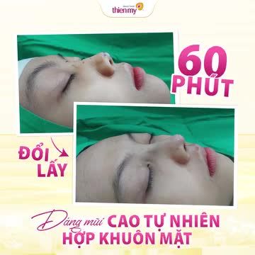 Kết quả nâng mũi sau 60p sẽ như thế nào?