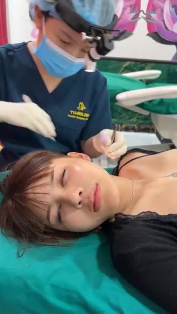 Case mũi Tái cấu trúc sau 10 ngày