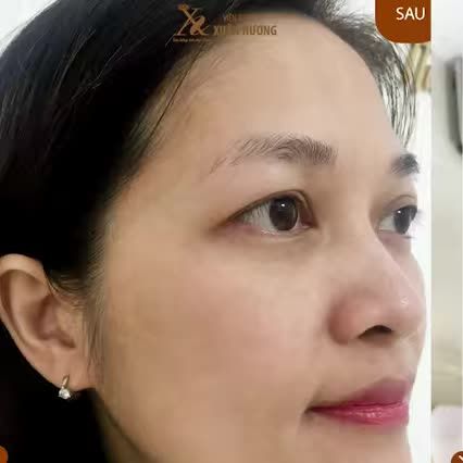 LOẠI BỎ NÁM DA - TỰ TIN VỚI LÀN DA SÁNG KHỎE