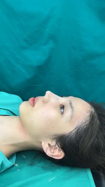 Case mũi bọc sụn vừa hoàn thành