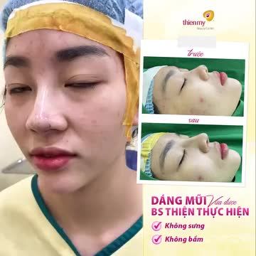 ĐẸP NỨC NỞ: Mũi bọc sụn vừa thực hiện xong