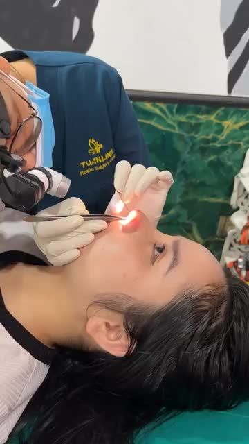 Case mũi bọc sụn 10 ngày