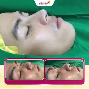 HOÀN THIỆN VẺ NAM TÍNH CHỈ VỚI 60P THỰC HIỆN NÂNG MŨI