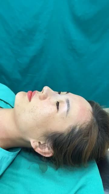 Case mũi bọc sụn vừa hoàn thành