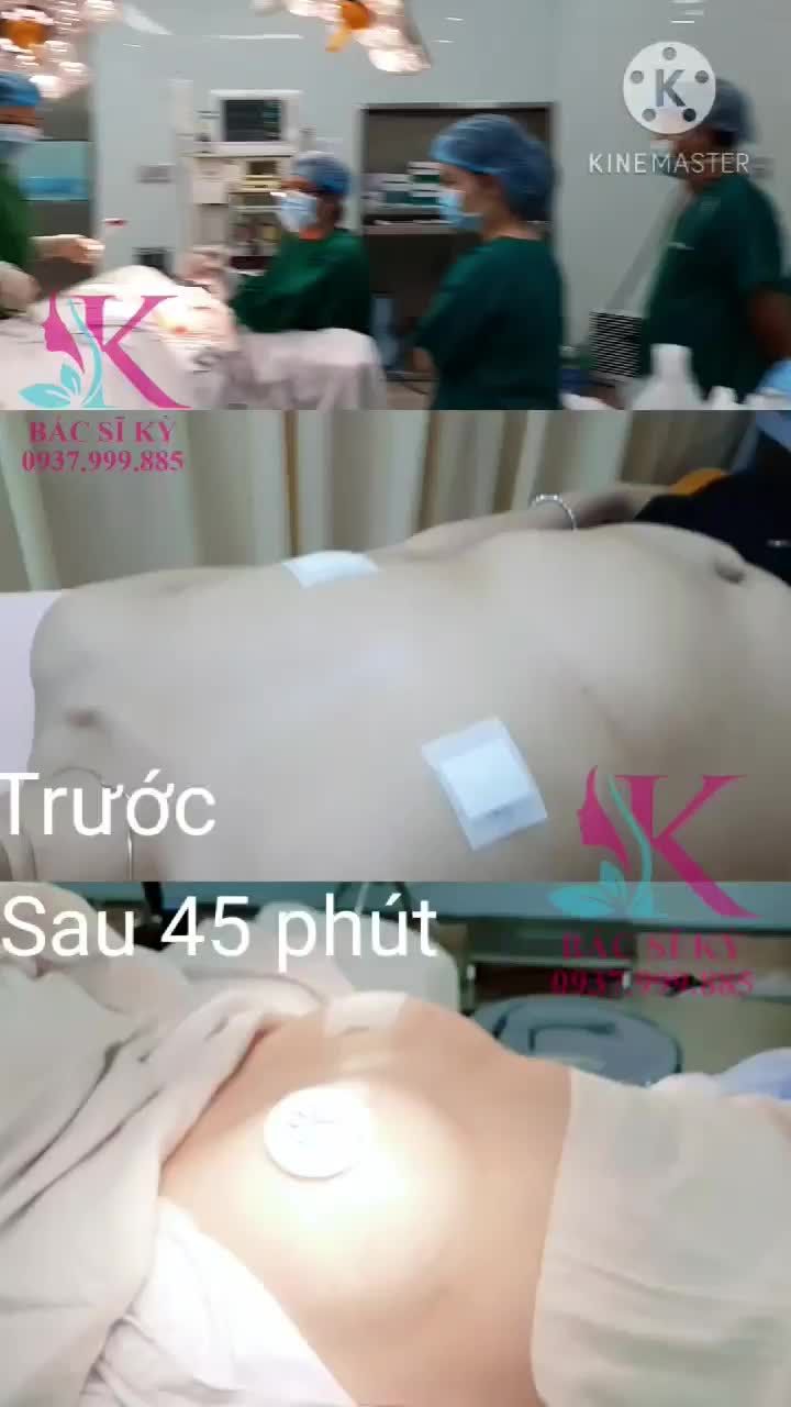 NÂNG NGỰC NỘI SOI CHÂN KHÔNG NHÀ BS KỲ Y DƯỢC CHƯA BAO GIỜ HẾT HOT