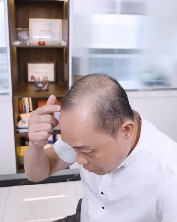 ĐÂU LÀ GIẢI PHÁP KHẮC PHỤC TÌNH TRẠNG TÓC THƯA - HÓI DI TRUYỀN