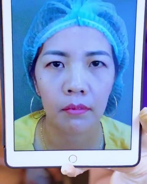 Sau tất cả, sau bao ngày mong chờ vị khách hàng đã sở hữu đôi mắt trẻ trung sang trọng khi chọn Dr.Hải Lê