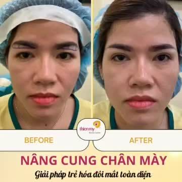 NÂNG CUNG CHÂN MÀY – LẤY LẠI THANH XUÂN CHO ĐÔI MẮT