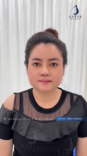 Chỉ 10 Ngày Có Ngay Mũi Đẹp...