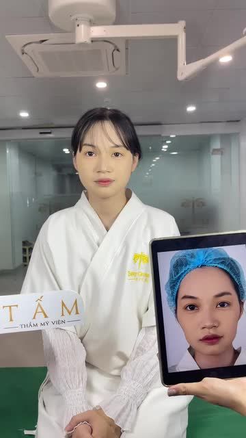 bạn khách đến Tấm với tình trạng má hóp và cằm ngắn, lẹm khiến khuôn mặt mất cân đối. Sau 30 phút thực hiện cân chỉnh, khuôn mặt bạn đã thay đổi rất nhiều, trông bầu bĩnh và hài hoà hơn.