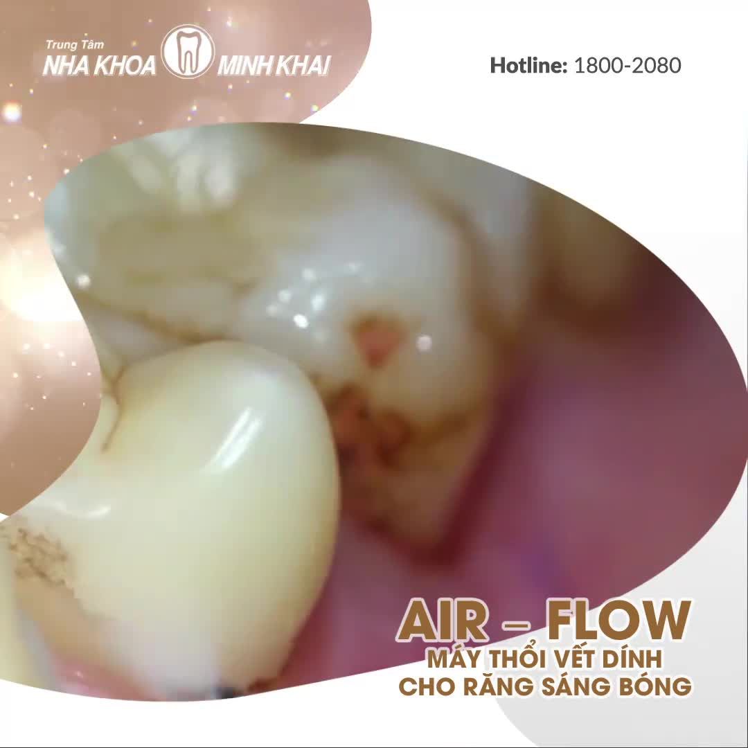 MÊ MẨN AIR – FLOW, MÁY THỔI VẾT DÍNH CHO RĂNG SÁNG BÓNG