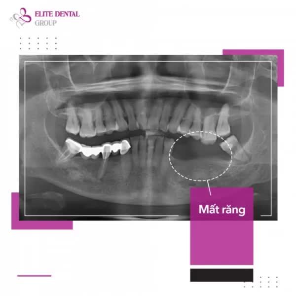 PHỤC HỒI RĂNG HÀM BỊ MẤT LÂU NĂM VÀ TIÊU XƯƠNG