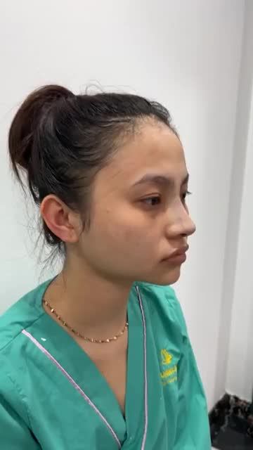Case mũi cấu trúc vừa hoàn thành
