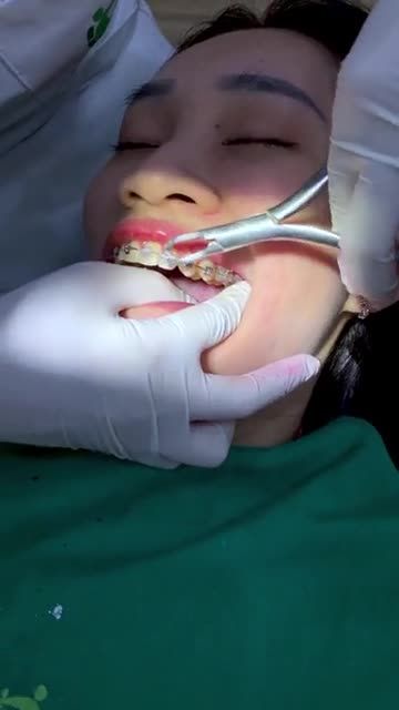 QUÁ TRÌNH THÁO MẮC CÀI CỦA MỘT CASE KHÁCH HÀNG NIỀNG RĂNG TẠI NHA KHOA GIA ĐÌNH