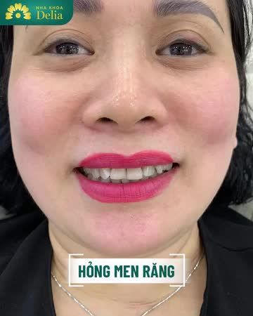 Cùng lắng nghe chị Việt Hà chia sẻ cảm nhận khi làm răng sứ tại Delia qua video sau