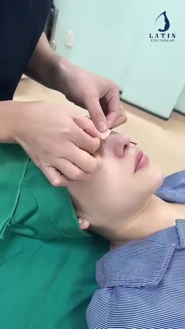 ẠI SAO PHẢI SỬ DỤNG NẸP ĐỊNH HÌNH SAU PT NÂNG MŨI