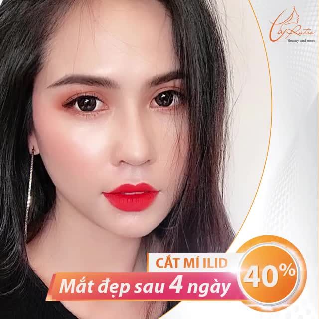 CẮT MÍ ILID - MẮT ĐẸP NGAY SAU 4 NGÀY