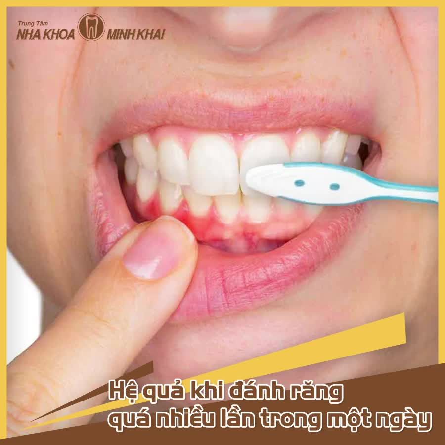 “Đánh răng vì đam mê” nhưng đừng quá lạm dụng kẻo để lại hậu quả khôn lường