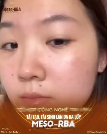 Chỉ sau 1 liệu trình Meso-RBA, làn da đã có sự cải thiện rõ rệt - Mụn viêm, mụn thâm không còn, da láng mịn, tràn đầy sức sống!