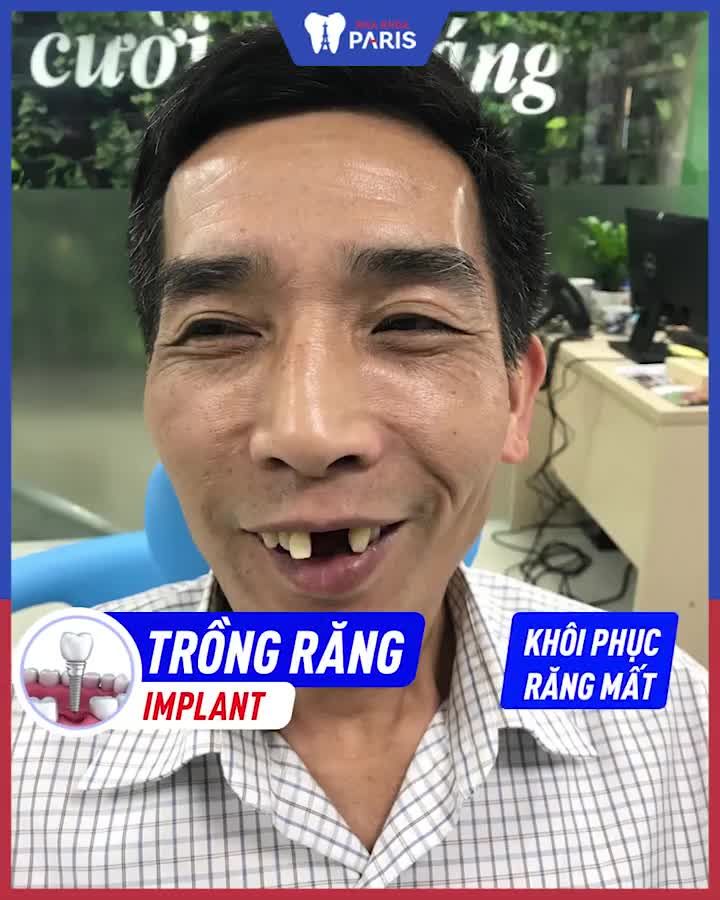 Hè này Trồng răng implant GIÁ HẠ NHIỆT: GIẢM 30% Trọn gói 12TR