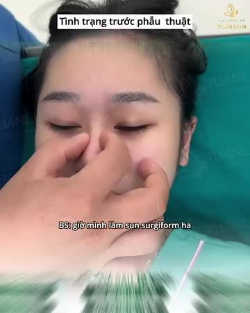 Cận cảnh dáng mũi, mí sau 10 ngày thực hiện tại Tuấn Linh.