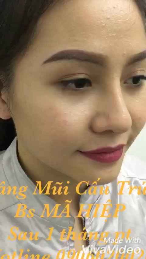 Nâng mũi cấu trúc - Bác sĩ Mã Hiệp - Ca 69