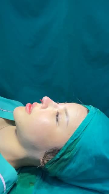 Case mũi tái cấu trúc vừa hoàn thành
