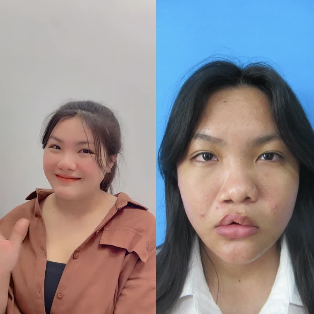 Quá ngạc nhiên và hạnh phúc trước thay đổi ngoạn mục của bạn KH thực hiện combo sửa sẹo môi và mũi.