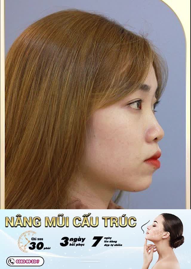 NÂNG MŨI CẤU TRÚC THIỆN MỸ - DÁNG MŨI NHƯ Ý, ĐẸP BỀN LÂU