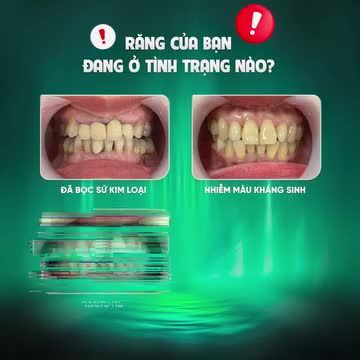 RĂNG CỦA BẠN ĐANG Ở TÌNH TRẠNG NÀO? KHẮC PHỤC NGAY TRƯỚC KHI QUÁ MUỘN