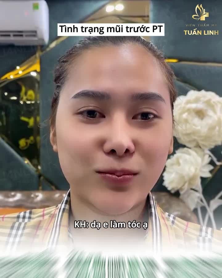 Mũi đã từng nâng bị lệch, đã sửa lại những vẫn bị méo, lệch và tuột sụn...Và lần này, chị chọn sửa lại tại Tuấn Linh!!