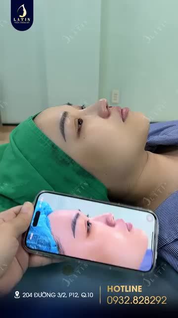 Nghe đồn Latin nâng mũi không đau, có thật không