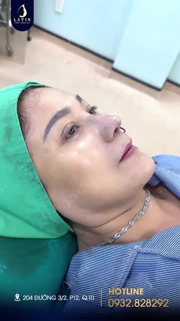 NÂNG MŨI CÔNG NGHỆ CẤU TRÚC CHO CHỊ GÁI ĐÃ TỪNG NÂNG MŨI