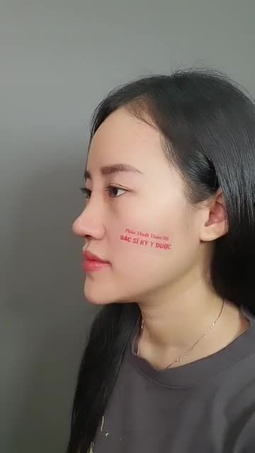 Bạn khách vừa tháo nẹp sau 6 ngày Nâng Mũi Aline.