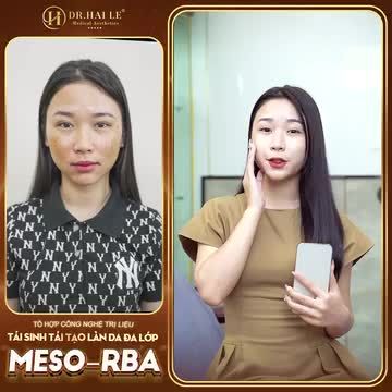 Với Meso-RBA, sở hữu làn da đẹp không còn là điều khó khăn