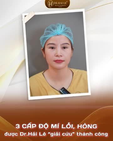 Chỉ 60 PHÚT thực hiện, Dr.Hải Lê sẽ giúp bạn xóa nỗi lo lắng - Khắc phục hoàn toàn nhược điểm mắt lỗi, trả lại vẻ đẹp tự nhiên, hài hòa cho đôi mắt của bạn!