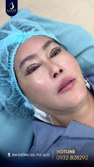 Cô khách đã 65 tuổi, định cư lâu dài bên Mỹ, nhiều lần về Việt Nam cắt mí nhưng không thành công. Cô tới Latin trong tình trạng nhược cơ mí mắt, mắt lờ đờ, không thể mở hết tròng mắt.