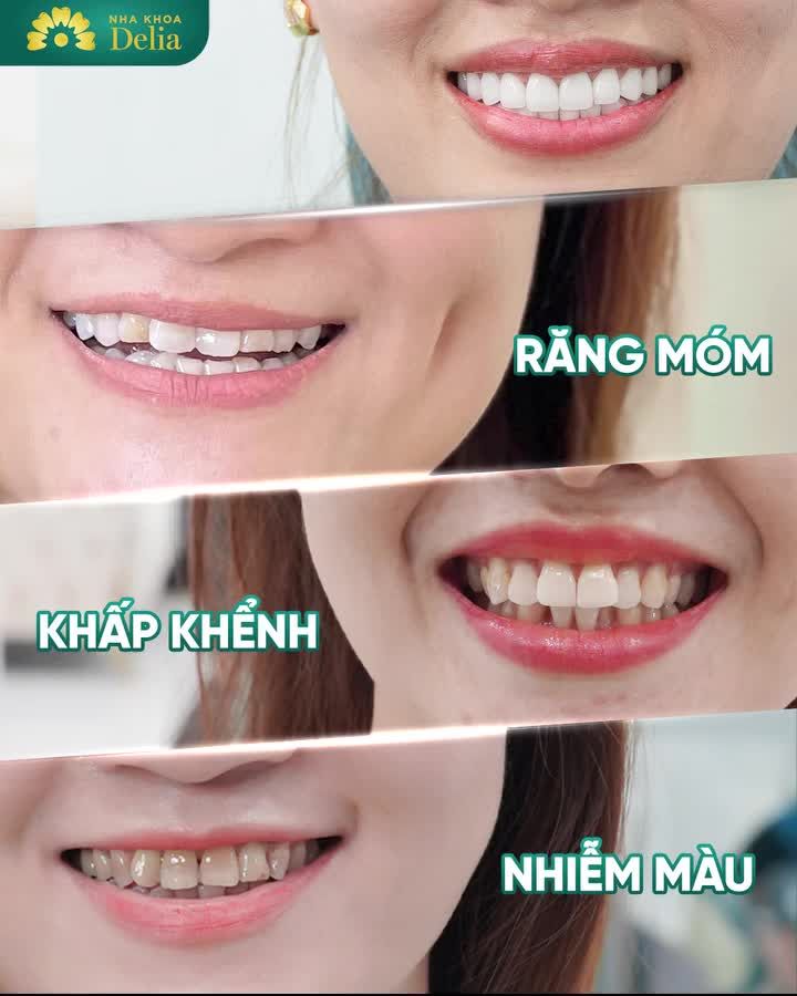 Bọc răng sứ thẩm mỹ tại nha khoa Delia