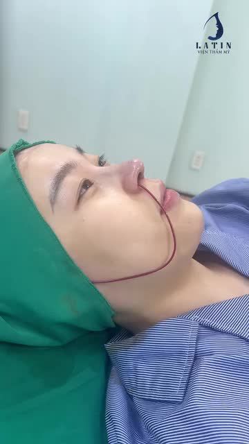 Ca mũi cấu trúc Surgiform vừa mới hoàn thành  đang được đặt ống dẫn lưu.