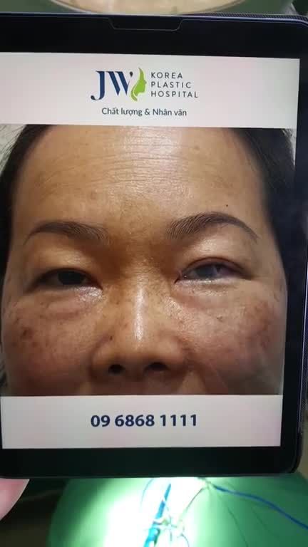 Quá trình hô biến U60 HÓA MỸ NHÂN nhờ phương pháp TREO CHÂN MÀY tại JW