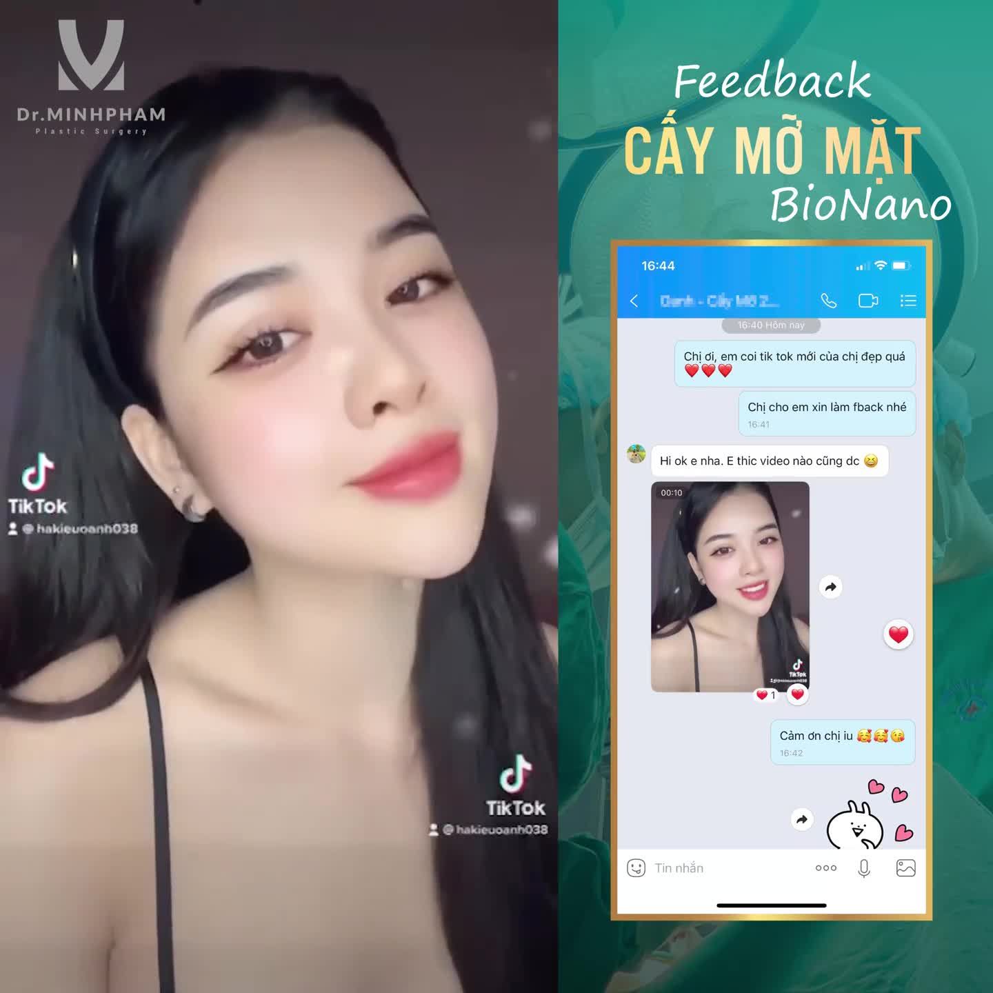 GƯƠNG MẶT CHUẨN DIỄN VIÊN VỚI CẤY MỠ MẶT BIONANO