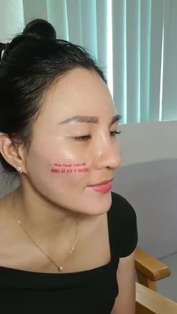 Kết Quả Nâng Mũi ALINE Sau 10 Ngày