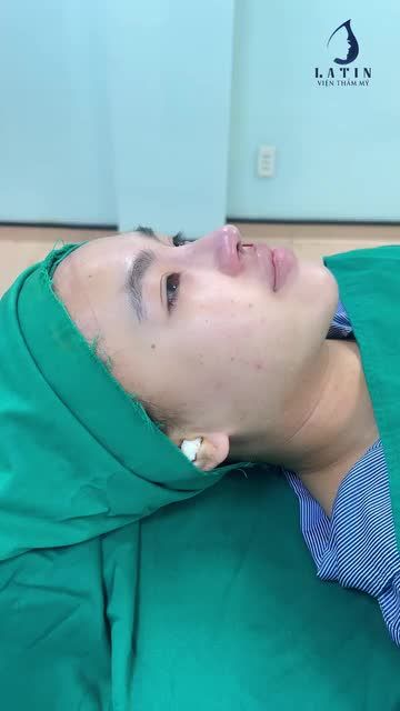 Hoàn thành ca mũi cấu trúc sóng Surgiform